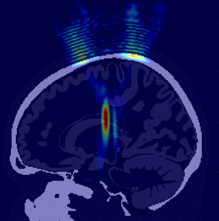 Numerical simulation of transcranial focused ultrasound